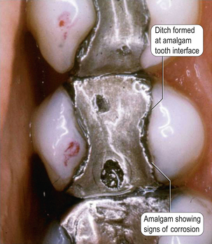 Amalgam marginal breakdown