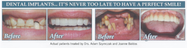before and after teeth before and after teeth