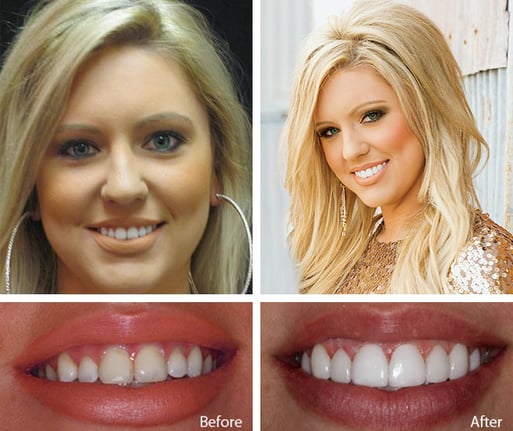 the illusion and appeal of dental veneers