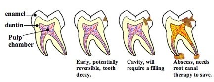 cavity can reverse