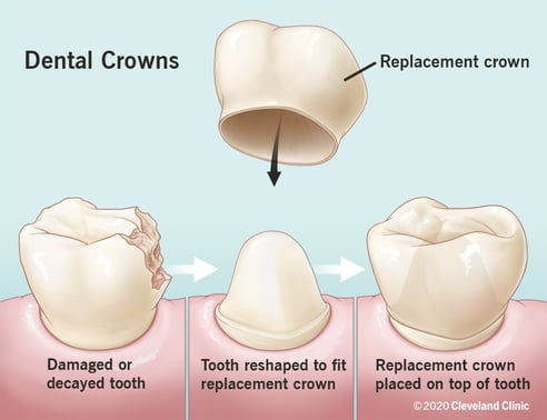 dental crown