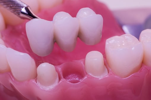 dental-bridges-preparation
