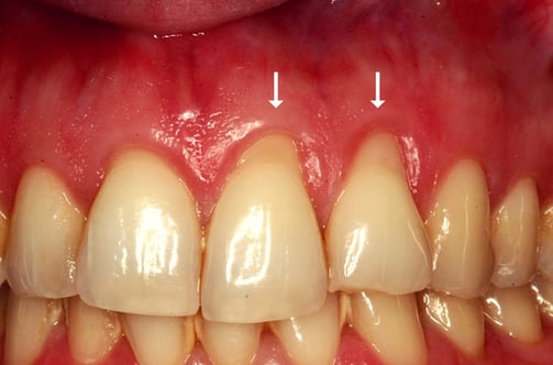 gum recession