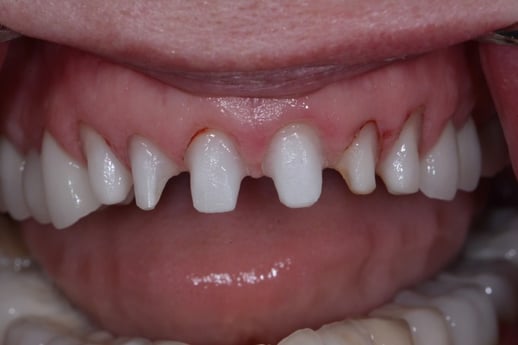 Teeth Veneers Strip Away Precious Natural Enamel